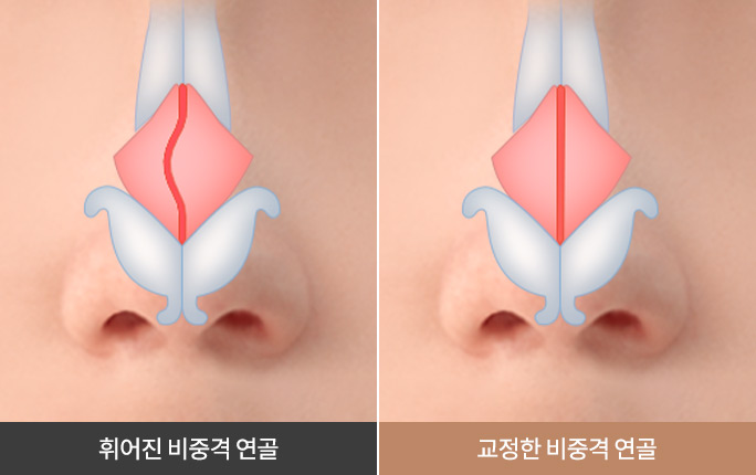 비중격 만곡증