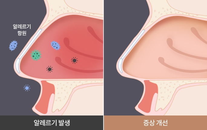 알레르기 비염