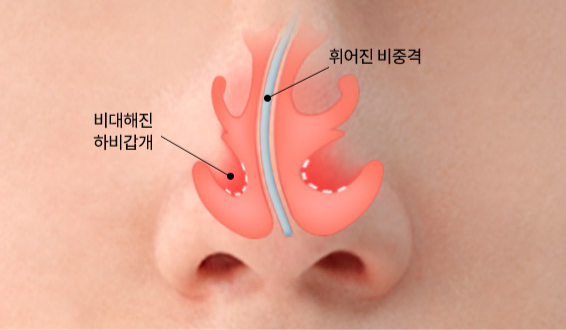 비중격만곡증