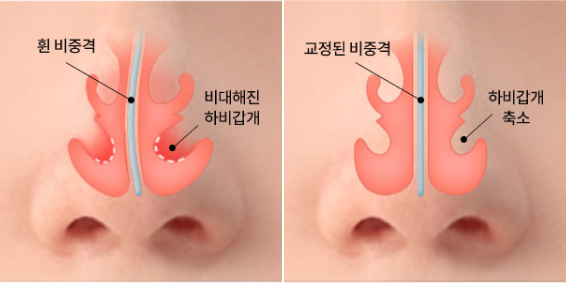 비중격 만곡증+코의 질환 치료