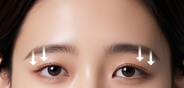 눈썹 처짐으로 답답해 보이는 눈매