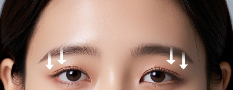 눈썹 처짐으로 답답해 보이는 눈매