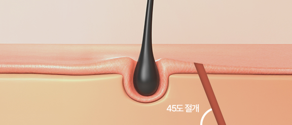 모근 45도 절개