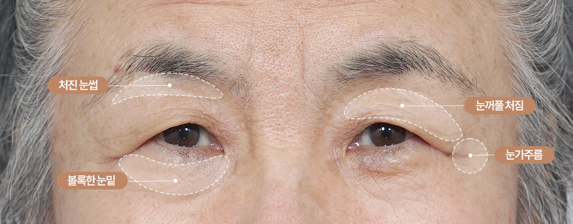 중년 눈성형