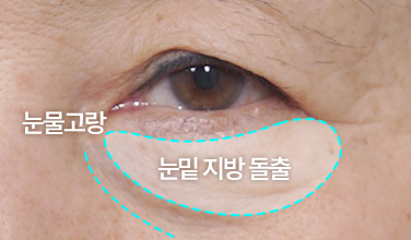 눈밑 지방