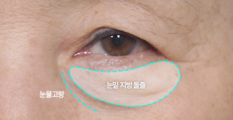 눈밑 지방