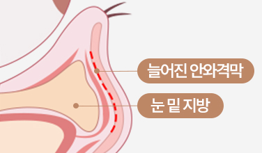격막강화