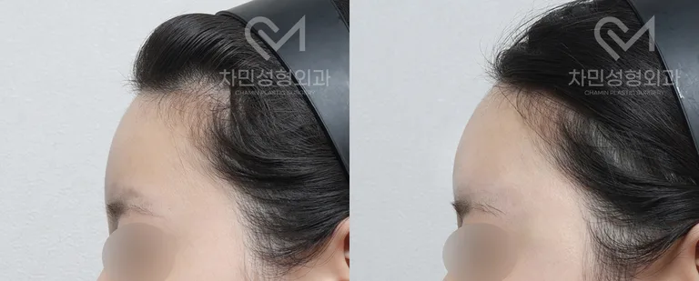 측면