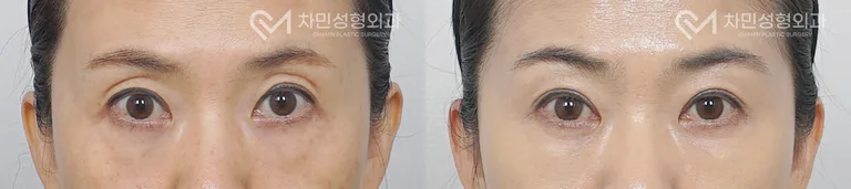 측면