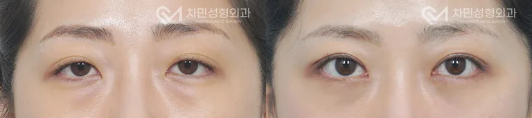 측면