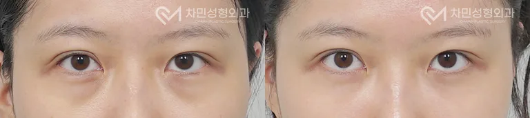 측면