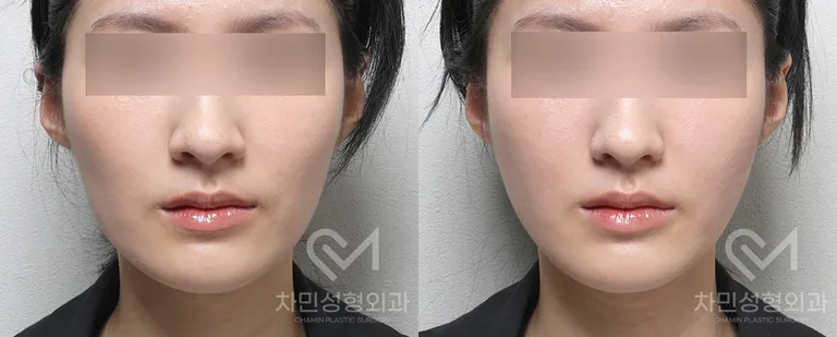 측면