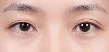양쪽 라인이 비대칭인 경우